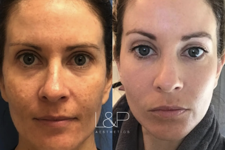 BBL Forever Young result from L&P Aesthetics. Woman's face before and after BBL treatments.